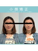 シンカ 湘南江ノ島 鵠沼(shinka)/【小顔矯正】Before/After