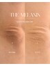 韓国最新黒ずみケア上陸！THE MELANIN【肘】￥37,500→￥34,500 (30分)
