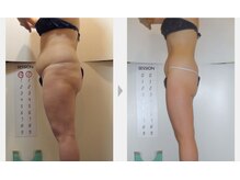 【エンダモロジー】冷たい、痛み、無し理想のボディを叶えます★