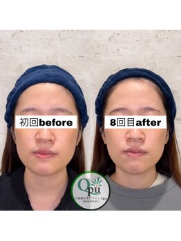 キュープ 相模原淵野辺店(Qpu)/たった4回で人生で1番小さな顔に