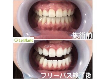ルブラン 奈良店(Le Blanc)/笑顔が映える白い歯!!