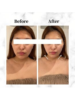 ザビューティー 麻布十番本店(The Beauty)/12Dリフト全顔打ち放題[リフト]