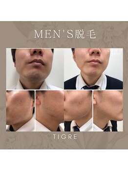 ティグレ 岡山店(TIGRE)/メンズ脱毛