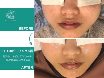 ベルスタイル(Bell style)/当店お客様症例(陶器ピーリング)