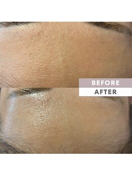 とぅるりん 肌質改善/おでこの黒ずみもスッキリ♪