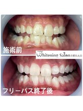 ホワイトニングサロン 京都烏丸店/ホワイトニング 施術例