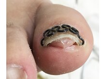 巻き爪矯正センター 沖縄 宜野湾/巻きが強い方のビフォーアフター