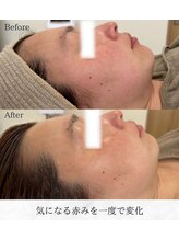 シロ(silo)/赤ら顔にお悩みの方