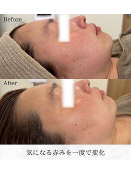 シロ(silo)/赤ら顔にお悩みの方