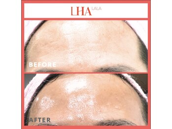 ランソ ビューティー 成田(RUNSO Beauty)/ララピール効果 つやとシワ