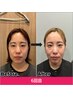 【美容鍼×姿勢改善×痛み】オールインワンコース体験60分￥12,000→5,980