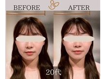 チョコバリ 新宿店(chocobari)/小顔×リフトアップ(美容鍼)20代