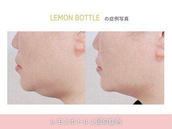 アメリイ 百合ヶ丘 新百合ヶ丘(Amerii)/【レモンボトル】1回の結果