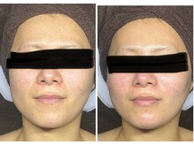 ポマイカイ 名古屋丸の内店(pomaikai)/ハイドロフェイシャル