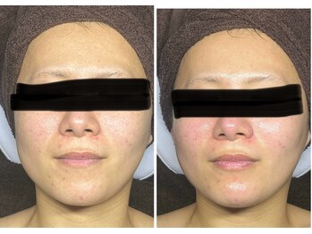 ポマイカイ 名古屋丸の内店(pomaikai)/ハイドロフェイシャル