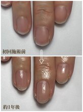ラピスネイル(Lapis Nail)/爪の健康を考えるコース