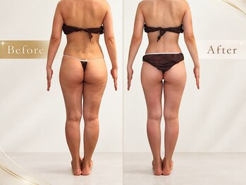 サロン ド モナ(salon de mona)の写真/【下半身セルライトケア】30代からの本気の美脚集中プログラム！浮腫み、セルライトケアで美脚づくり★