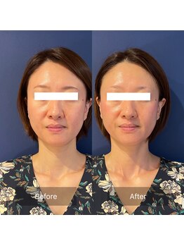 フフラ KANコルギセラピー山梨本店(fufla)/小顔ソムリエ【小顔 頭蓋骨】