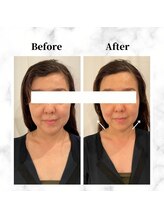 ザビューティー 麻布十番本店(The Beauty)/12Dリフト全顔打ち放題[リフト]