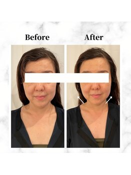 ザビューティー 麻布十番本店(The Beauty)/12Dリフト全顔打ち放題[リフト]