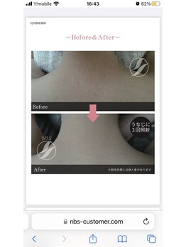 グリン(grin)/脱毛