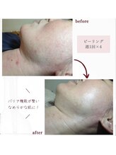 ファヴォリ(favori)/透光ピーリング