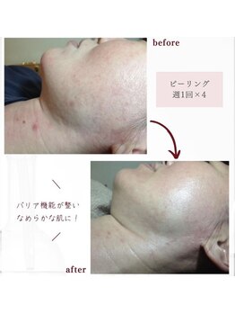 ファヴォリ(favori)/透光ピーリング