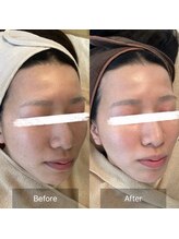 モカ 天王寺店(MOKA)/剥離◯3回目　ハーブピーリング