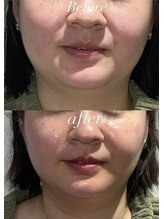 レシェルサロン(Lechelle Salon)/レモンボトルお顔3部位