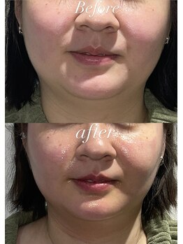 レシェルサロン(Lechelle Salon)/レモンボトルお顔3部位