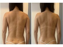 モア(moa)/猫背解消、肩甲骨剥がし