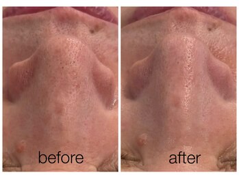 ハリスキンラボ(Hari.Skin.Lab)/60代のお客様/1回の施術効果