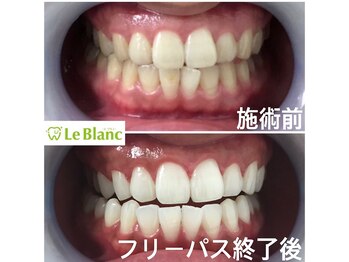 ルブラン 奈良店(Le Blanc)/手軽に簡単に白く！