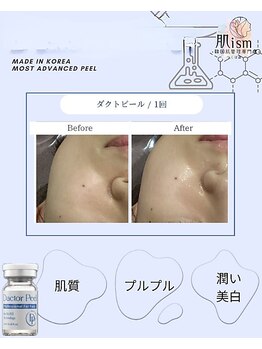 肌イズム 守谷店(肌ism)/【before&after】ダクトピール