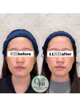 キュープ 相模原淵野辺店(Qpu)/たった4回で人生で1番小さな顔に