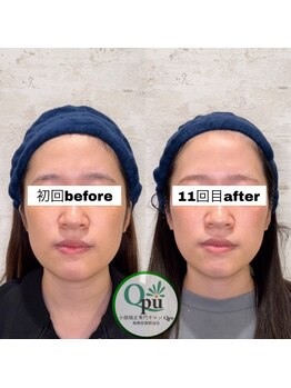 キュープ 相模原淵野辺店(Qpu)/たった4回で人生で1番小さな顔に