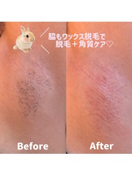 ココカナ(COCOKANA)/脇もワックス脱毛で黒ずみ改善◎