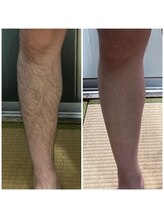 エヌ スタイル(N Style)/メンズ脱毛 