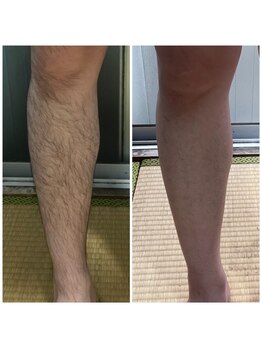 エヌ スタイル(N Style)/メンズ脱毛 