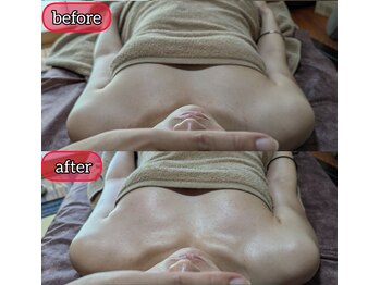 スノードロップ(snowdrop)/20代の方　１回の変化