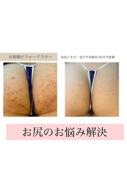 クウラ 学園前店(KUULa)/お尻も綺麗に！！