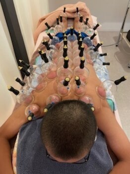 ひさたに整骨院 整体院/カッピング風景