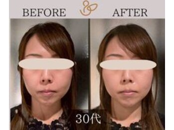 チョコバリ 新宿店(chocobari)/小顔×リフトアップ(美容鍼)30代