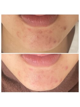 グリンプラス(grin+)/シミ改善/桂駅/フェイシャル