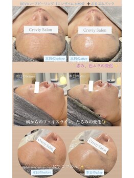クレヴィー(Creviy)/陶肌トリートメント《Special》