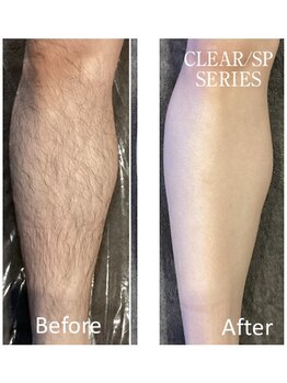 アットイカウ 下北沢(at ikaw)/両脚すね毛脱毛 Before/After