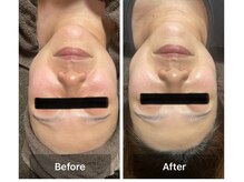 サンタ(SANTA.)/ララピール《ビフォーアフター》