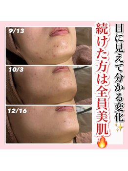 アルムダアクア 天王寺店(Aleumda AQUA)/ハーブピーリング/大阪/天王寺