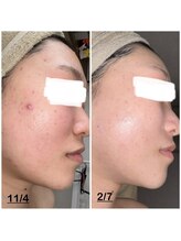 ミニョン(mignon)/モニター結果！