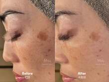 マウ(Mau)/シミケア